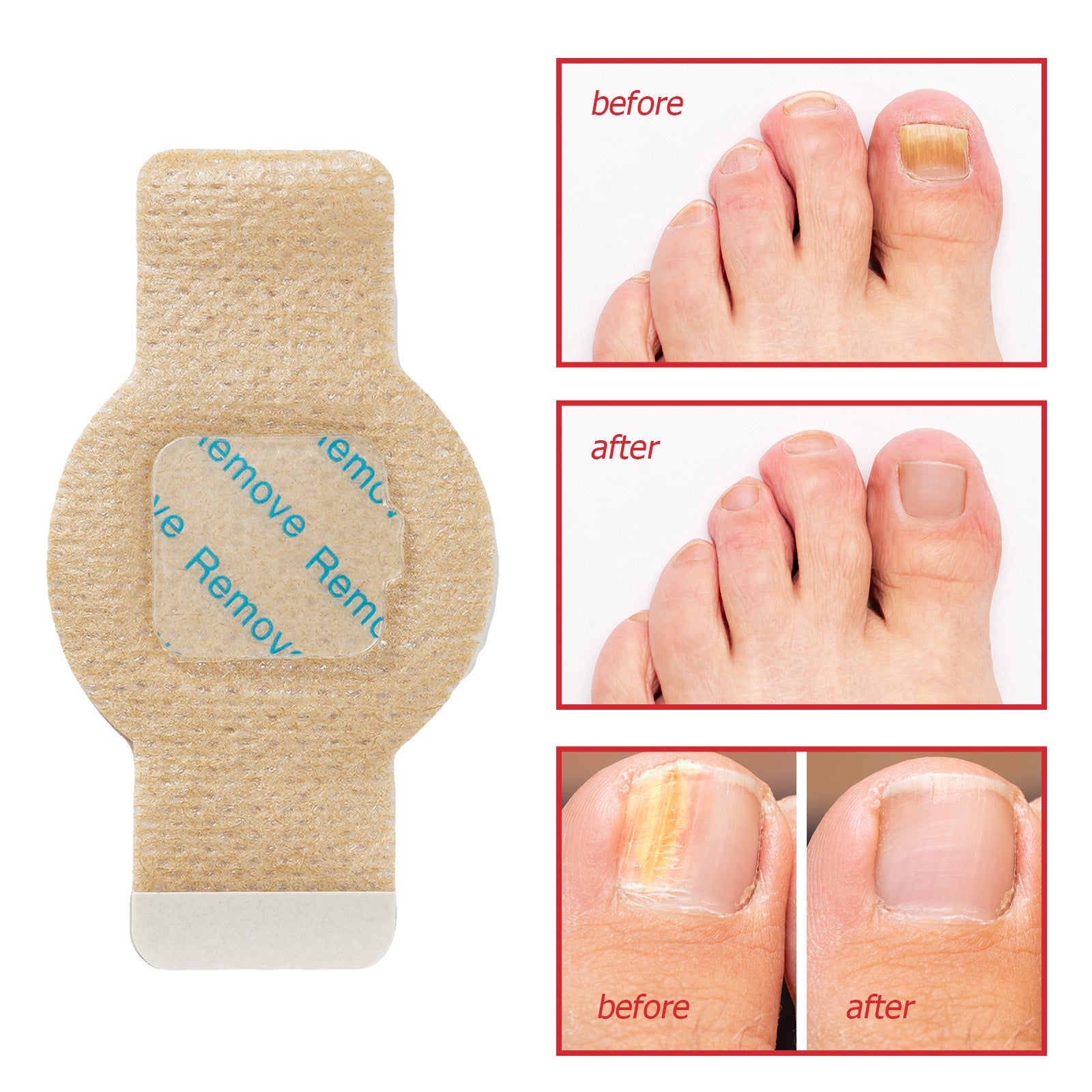 Toenail removal patch with 'before' and 'after' images of a foot.