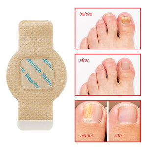 Toenail removal patch with 'before' and 'after' images of a foot.